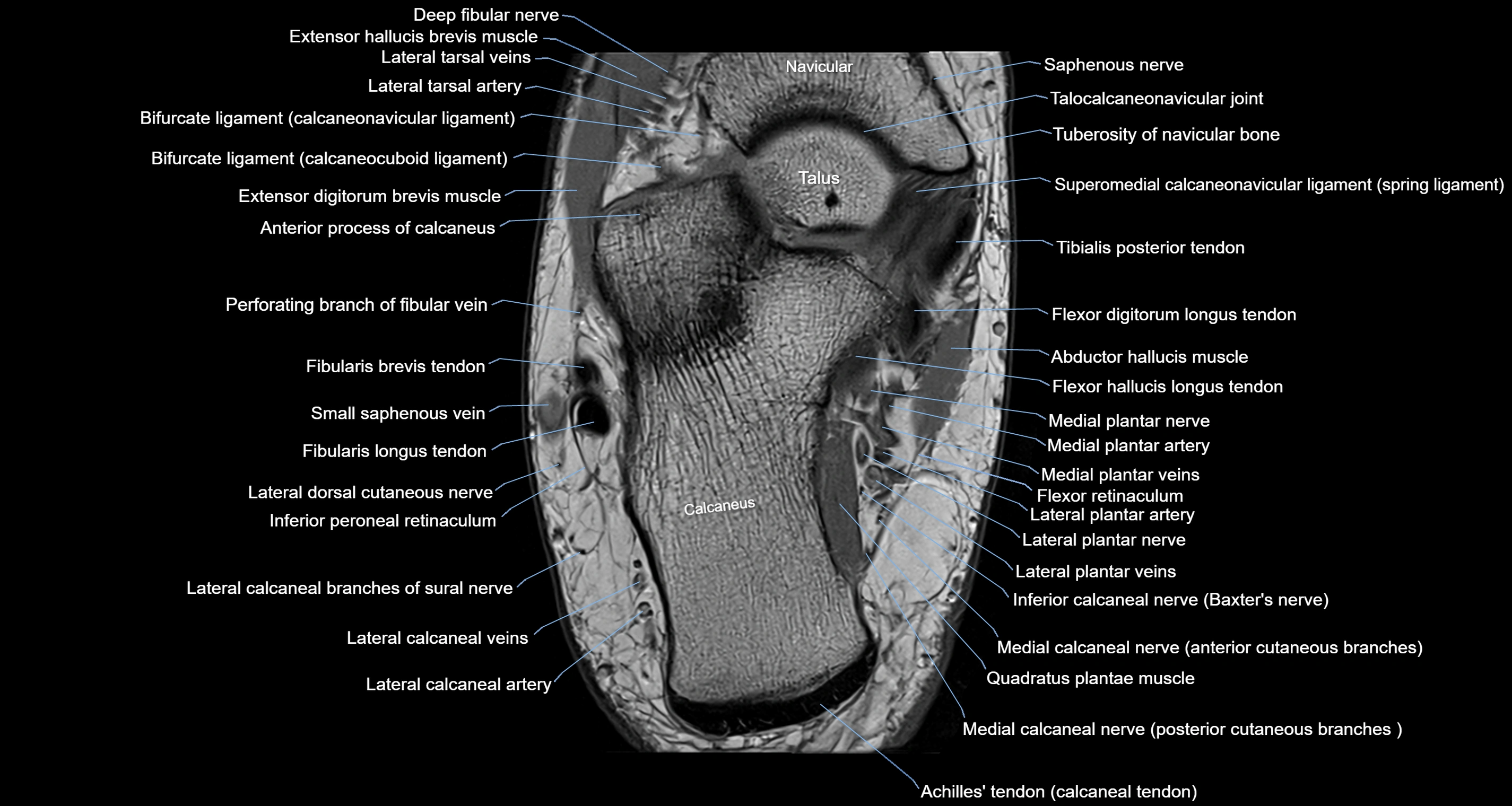 Ankle axial anatomy 3T MRI images -img-10001-00027.webp